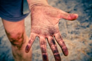 敏感肌の人におすすめのワキガケア方法は？